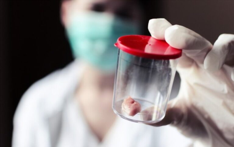 Biópsia de mama: quando ela é necessária e como funciona?