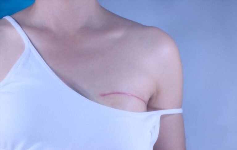 Mastectomia preventiva, quando optar pela cirurgia?