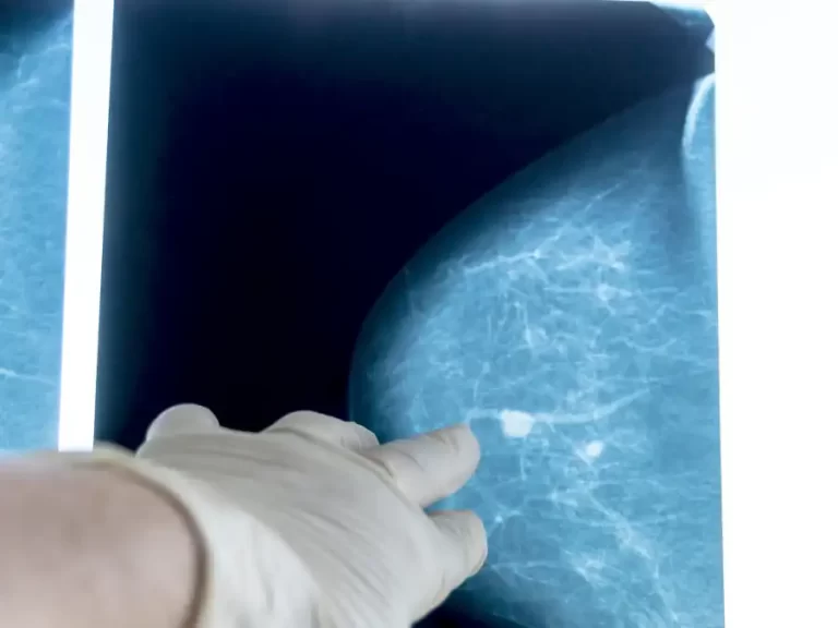 Cistos Mamários Espessos: Alerta?